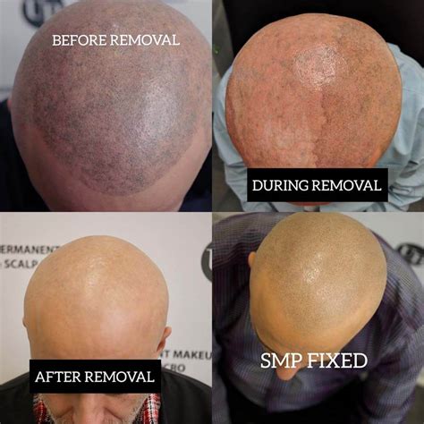 scalp micropigmentation regret